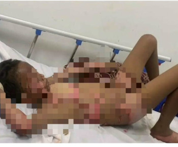 Kedapatan Mencuri Teri, Bocah ini Disirami Bensin Lalu Terbakar