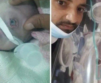 Kasus Langka Bayi Bermata Satu Lahir di Yaman, Ahli Belum Bisa Pastikan Penyebabnya