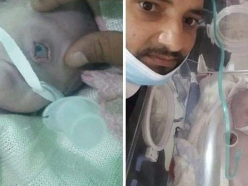 Bayi bermata satu
