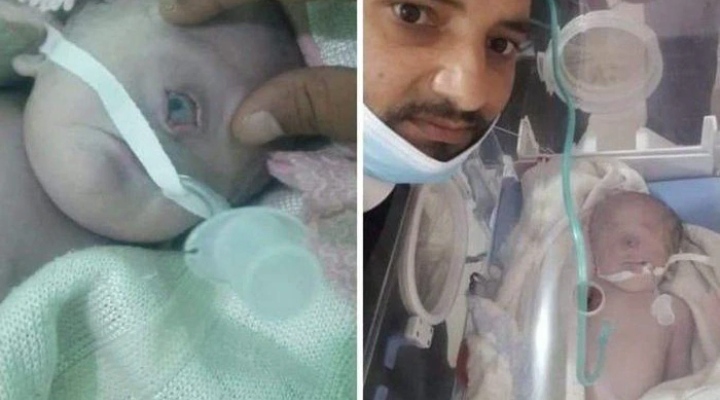Bayi bermata satu