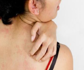 Scabies Serang Warga Fatuleu Barat, Sosok Pemuda ini minta Perhatian Khusus Pemerintah