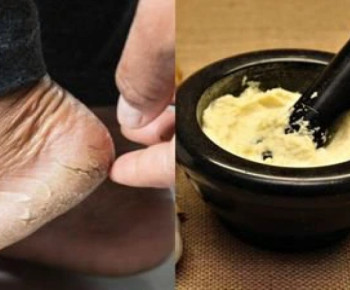 Murah Meriah Cara Mengatasi Kaki dan Tumit Pecah-Pecah, Cuma Dioles Madu Campur Bawang Putih