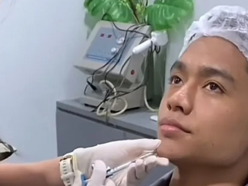 Betrand Peto Suntik Filler Dagu, Warganet Sebut Mirip Ivan Gunawan