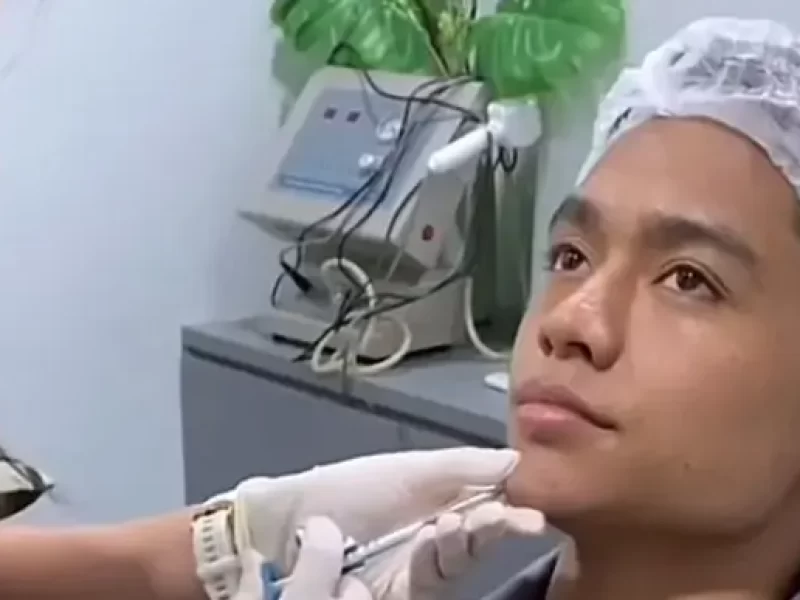 Betrand Peto Suntik Filler Dagu, Warganet Sebut Mirip Ivan Gunawan