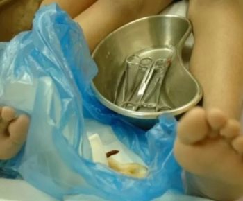 Buruk Buat Kesehatan, Tantangan Menghapus Tradisi Sunat Perempuan di Daerah